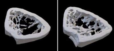 3D models of bone from mice in simulated menopause. Bone from mice with excess LRAP (right) was thicker and denser than bone from mice with normal levels of LRAP (left). Image courtesy of Ashok Kulkarni, PhD.