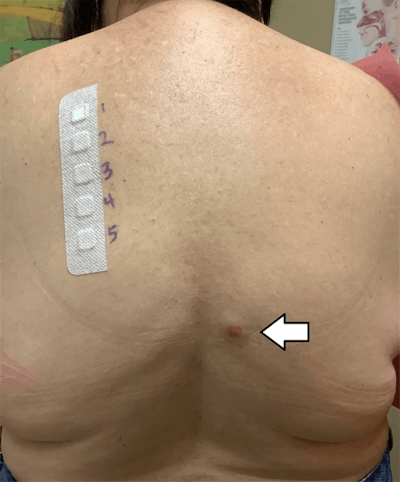 The patient underwent allergy testing for various heavy metals. The white arrow points to an erythematous papule that denotes a positive test for gold sodium thiosulfate. Image courtesy of Rasul et al. Licensed under CC BY 4.0.