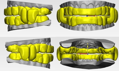 Design proposal of the oral sleep appliance.