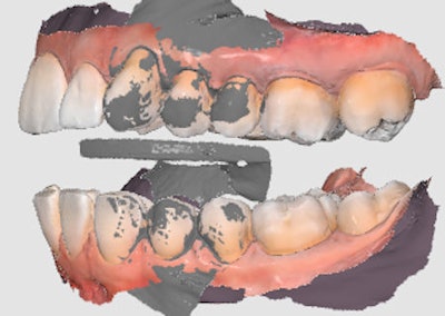 The patient's digital bite registration.