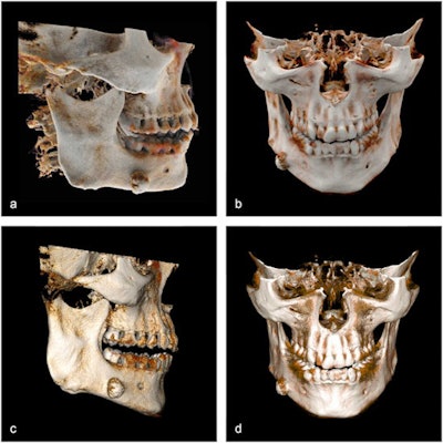 (A, B) Cinematic-rendering reconstruction of an exostosis of the right mandibular corpus, oblique-lateral view. (C, D) Volume-rendering reconstruction of the same dataset. Images and caption courtesy of Steffen et al and Annals of Anatomy. Licensed under CC BY 4.0.