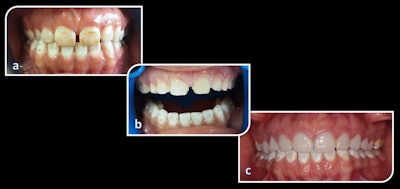 A patient with advanced fluorosis (a). The same patient during preparation for ceramic veneers (b). The patient after receiving veneers (c). All images courtesy of Demirekin et al. Licensed under CC BY 4.0.