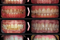 2022 02 18 00 07 6264 2022 02 18 Veneers2 20220218005250