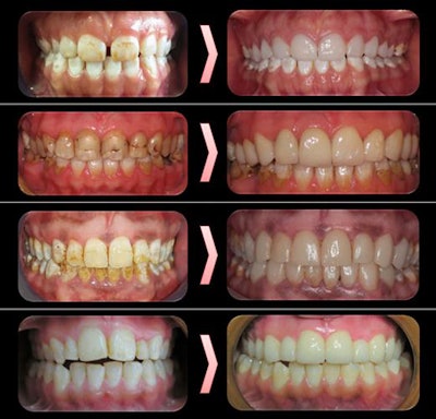 Before and after photos of patients at 10-year follow-up.