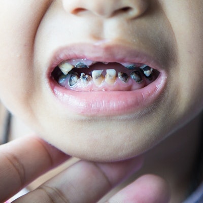 2020 01 16 22 52 5146 Child Caries Tooth Decay 400