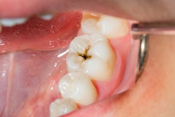 2021 10 28 22 29 5765 Tooth Caries Cavity 400