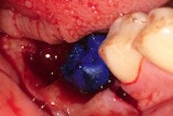 2022 03 03 18 00 0502 2022 03 08 Tooth Transplant 400