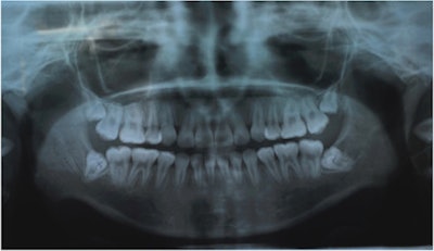 Pre-extraction panoramic x-ray showing complete bony impacted third molars. All images courtesy of Heifetz-Li et al. Licensed by CC BY 4.0.