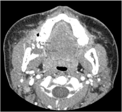A CTA maxillofacial with contrast shows a peripherally enhanced collection adjacent to the extraction socket of tooth #32, as well as cortical breakthrough along the medial surface of the right mandibular ramus.