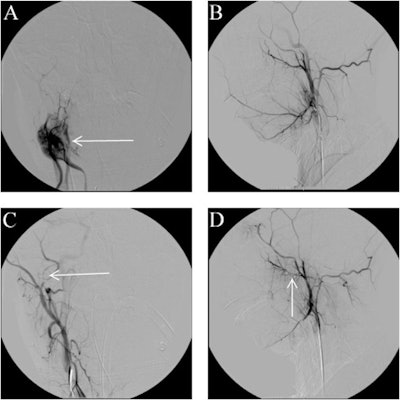 A, B: An interventional cerebral angiogram shows contrast extravasation and a pseudoaneurysm arising from the inferior alveolar branch of the right internal maxillary artery (see arrow, panel A). C, D: Angiogram following coil embolization across the origin of the right inferior alveolar artery (see arrow, panel C and D).