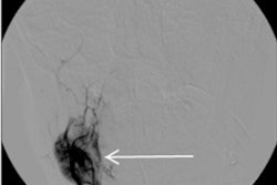 2022 03 21 17 22 9116 2022 03 21 Pseudoaneurysm Image 3 400