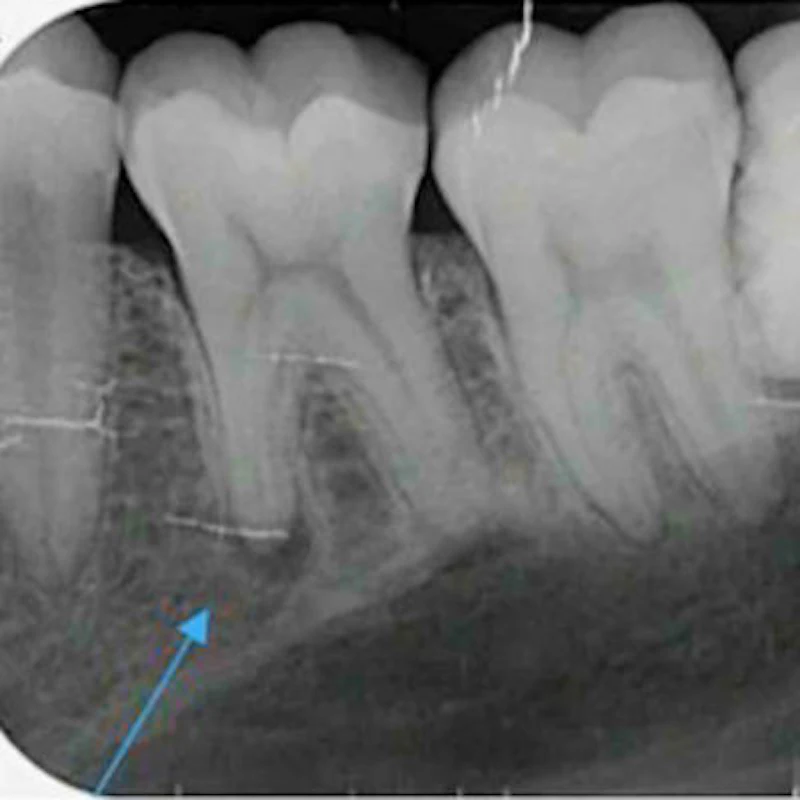 X-rays reveal man's bruxism-caused apical periodontitis | DrBicuspid.com