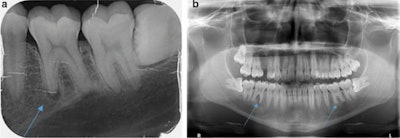 a: An x-ray taken in October 2019 shows apical osteolysis in tooth #36. b: An x-ray taken in October 2019 shows apical osteolysis in tooth #36 and #46. The osteolysis is greater in tooth #46.