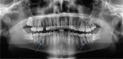 The patient's routine x-ray taken by a primary dentist in January 2019 reveals that tooth #36 and #46 showed no signs of apical osteolysis before the intense bruxism started. The teeth also did not show visible signs of caries or fillings. All images courtesy of Gund et al. Licensed by CC BY 4.0.