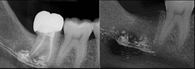 On the left, a dental x-ray shows apical radiolucency, with superimposed radiopaque sealer material extruding at the root tips of endodontically treated tooth #47. On the right, the x-ray shows its presence in socket 47 after extraction. All images courtesy of Mahmood et al. Licensed CC BY 4.0.
