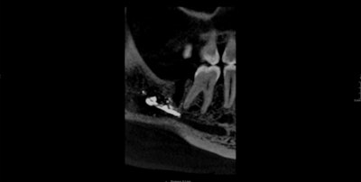 Cone-beam CT shows the remnants of radiopaque sealer material left behind from previous endodontically treated and extracted tooth #47, with associated radiolucency suggestive of chronic infection.