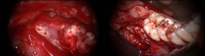 The left image shows widespread fibrosis and necrotic nerve tissue in the apical region of extracted tooth #47. The right image shows foreign material on the external surface and within the nerve epineurium.