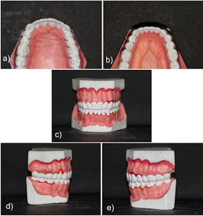 Image caption and attribution: Photos of five regions of a dental cast taken by the cameras, including the a) maxillary occlusal view, b) mandibular occlusal view, c) view in occlusion, d) right lateral view in occlusion, and e) left lateral view in occlusion. All images courtesy of Kumar et al. Licensed by CC BY 4.0.