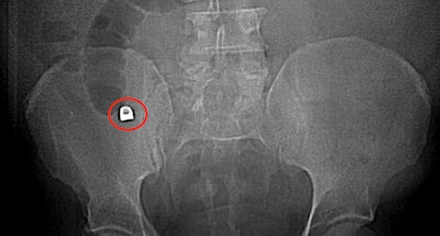 An abdominal x-ray revealed a 1 x 0.9 cm metallic density, which ended up being a dental crown, in the appendix near its origin in the cecum. Images courtesy of Brennan et al. Licensed by CC BY 4.0.