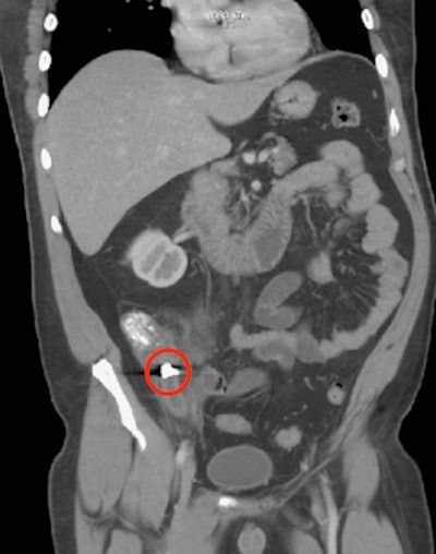 A CT scan also confirmed a metallic object -- a dental crown -- in the patient's appendix.
