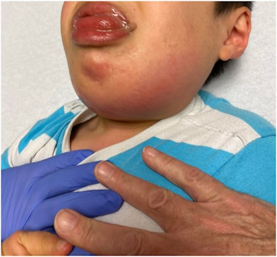A 6-year-old diagnosed with nonverbal autism experienced rapid onset tongue protrusion and swelling following submandibular gland ligation. Image courtesy of Scott et al. Licensed CC BY 4.0.