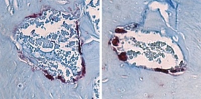 Bone-degrading cells (maroon) in the jawbone marrow of mice. The cells are smaller in the mice lacking all microbes (left) than those in mice with the SFB gut microbe associated with jawbone loss (right). Image courtesy of Novince Lab.