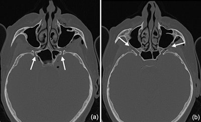 2022 05 05 16 43 2713 2022 05 06 Pneumocephalus Dental Polisher 2 Resized