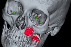 2022 05 05 16 43 2869 2022 05 06 Pneumocephalus Dental Polisher 400