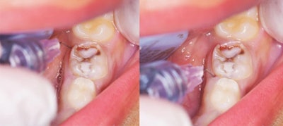 Administration of computer-controlled intraligamentary anesthesia in a child's multirooted tooth. On the left, first insertion on the distolingual line angle of the tooth. On the right, second insertion on the mesiolingual line angle of the tooth. Image courtesy of Helmy et al. Licensed by CC BY 4.0.