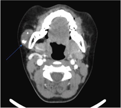 An axial CT with contrast image reveals a lesion in the 12-year-old's right parotid gland of intermediate density containing internal foci of calcification. Images courtesy of Garry et al. Licensed by CC BY 4.0.