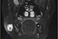 2022 05 26 14 34 7735 2022 05 26 Parotid Plebolith 2 400