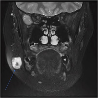 An arrow labels a well-circumscribed, T2 hyperintense lesion on a coronal T2 MRI neck scan. The lesion has a focal area of low intensity internally, located in the right parotid gland.