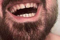 2022 06 01 14 14 4762 2022 06 01 Pterygoid Abscess1 400