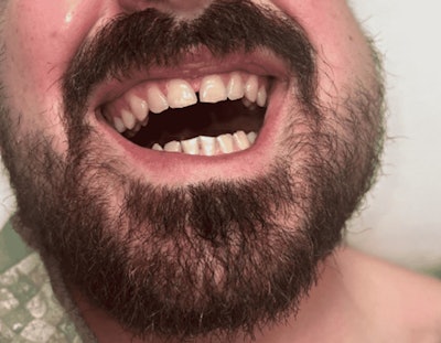 A 26-year-old man presented with facial swelling on his left side and trismus. Images courtesy of Cordero et al. Licensed by CC BY 4.0.