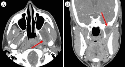 A maxillofacial CT scan reveals an infratemporal fossa abscess of the man's lateral pterygoid. A: Axial CT of the abscess. B: Coronal CT of the abscess.