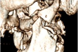 2022 06 14 16 32 1466 2022 06 14 Traumatic Necrosis 2 400