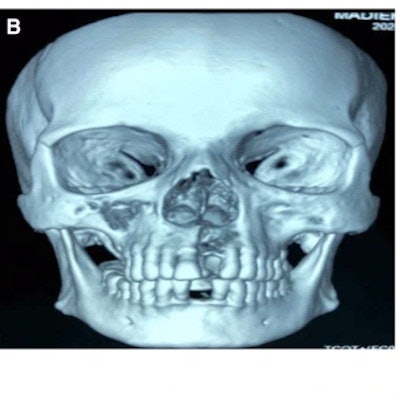 2022 06 17 16 29 6533 2022 06 17 Covid 19 Osteonecrosis 400