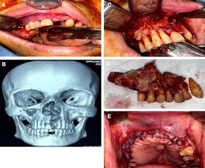 Report of a case with post-COVID-19-related osteonecrosis of the jaw. A. Image shows multiple maxillary buccal fistula oozing pus. B. A 3D volumetric rendering of a CT scan shows a necrotic right maxillary segment extending to the right maxillary sinus and toward the maxillary left lateral incisor. C. Image shows necrotic bone exposure via sulcular incision. D. Image shows the extent of the resected segment of the jaw. E. Image of postoperative defect extent and wound water-tight suturing. Images courtesy of El-Mahallawy et al. Licensed by CC BY 4.0.