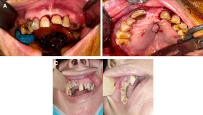 A variant clinical picture, which may be present in patients with post-COVID-19-related osteonecrosis of the jaw. A. Image of a mobile dentoalveolar maxillary segment with intact mucosal bone coverage. B. Image of palatal swelling. C. Image of mucosal ulceration and exposed necrotic bone.