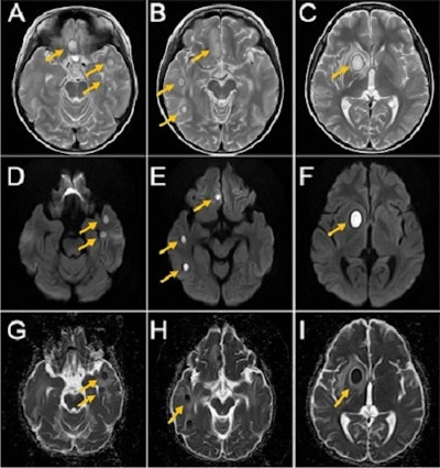 MRI of the boy’s brain obtained on September 26, 2020. T2-weighted image (A, B, and C), diffusion-weighted image (D, E, and F), ADC map (G, H, and I). Yellow arrows indicate brain abscesses. There were multiple nodular lesions showing ring-like hyperintensity in T2-weighted images and internal hyperintensity and decreased ADC in diffusion-weighted images.