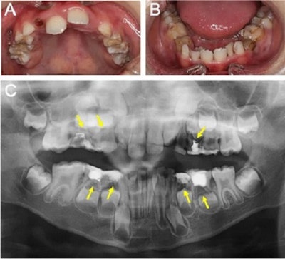 Clinical and x-ray findings of the boy at the initial visit. Intraoral photograph (A and B) and panoramic x-ray (C) of the boy at his initial visit. Yellow arrows indicate apical periodontitis.