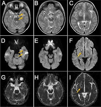 MRI obtained of the boy's brain obtained on November 11, 2020. T2-weighted image (A, B, and C), diffusion-weighted image (D, E, and F), ADC map (G, H, and I). Yellow arrows indicate brain abscesses. Images courtesy of Kikuiri et al. Licensed by CC BY 4.0.