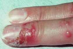 2022 07 21 17 55 3939 2022 07 22 Herpetic Whitlow 400