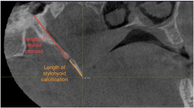 CBCT in the sagittal plane reveals the length of the styloid process and the length of the stylohyoid ligament calcification. Image courtesy of Al-Amad et al. Licensed by CC BY 4.0.