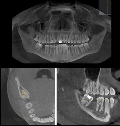 Multiple CBCT slices revealed the unilateral fused third with a continuous pulp chamber. The axial view revealed the tooth had five canals.