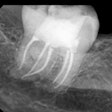 2022 08 02 16 58 0792 2022 08 01 Fused Mandibular Molar Fig 4 400