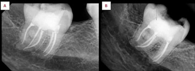 An intraoral x-ray shows (A) a postoperative x-ray of the man's fused third molar with supernumerary tooth and (B) a six-month follow-up x-ray that shows normal bone appearance.