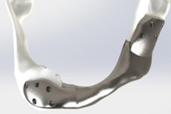 2022 08 09 15 38 0445 2022 08 09 Nci Titanium Jaw 400
