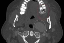 2022 08 16 16 02 2106 2022 08 16 Ica Aneurysm Fig1 400