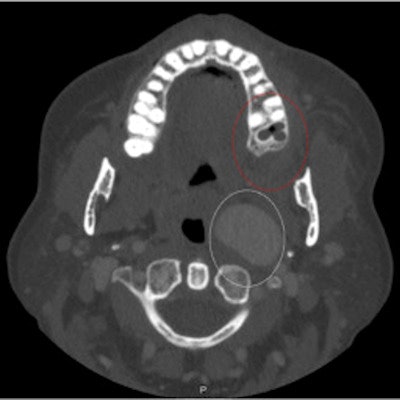 2022 08 16 16 02 2106 2022 08 16 Ica Aneurysm Fig1 400